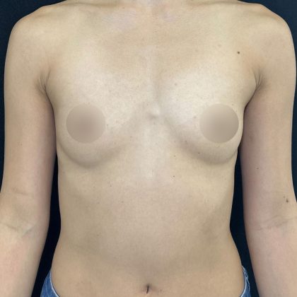 Preserv&eacute; Breast Augmentation Before & After Patient #5318