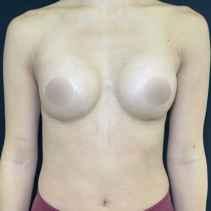 Preserv&eacute; Breast Augmentation Before & After Patient #5318