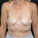 Preservé Breast Augmentation Before & After Patient #5319