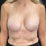 Preservé Breast Augmentation Before & After Patient #5319