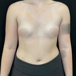 Preservé Breast Augmentation Before & After Patient #5320