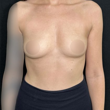 Preserv&eacute; Breast Augmentation Before & After Patient #5321