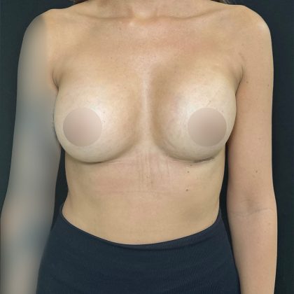 Preserv&eacute; Breast Augmentation Before & After Patient #5321