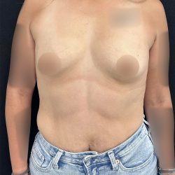 Preservé Breast Augmentation Before & After Patient #5322
