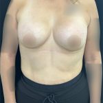 Preservé Breast Augmentation Before & After Patient #5322