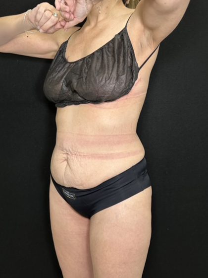 Tummy Tuck Before & After Patient #5373